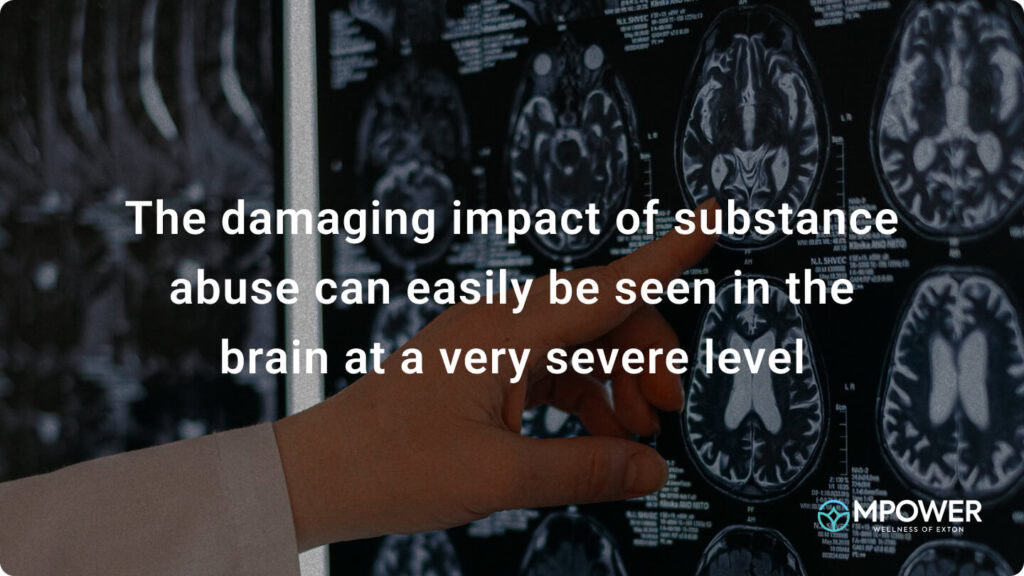 The damaging impact of substance abuse can easily be seen in the brain at a very severe level